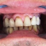PRE