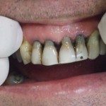 PRE